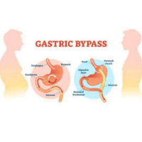 How To Restart Weight Loss After Gastric Bypass Tips